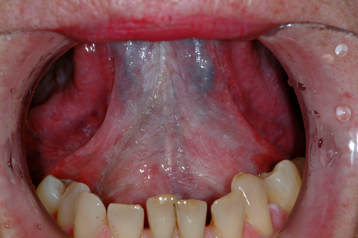 speckled leukoplakia