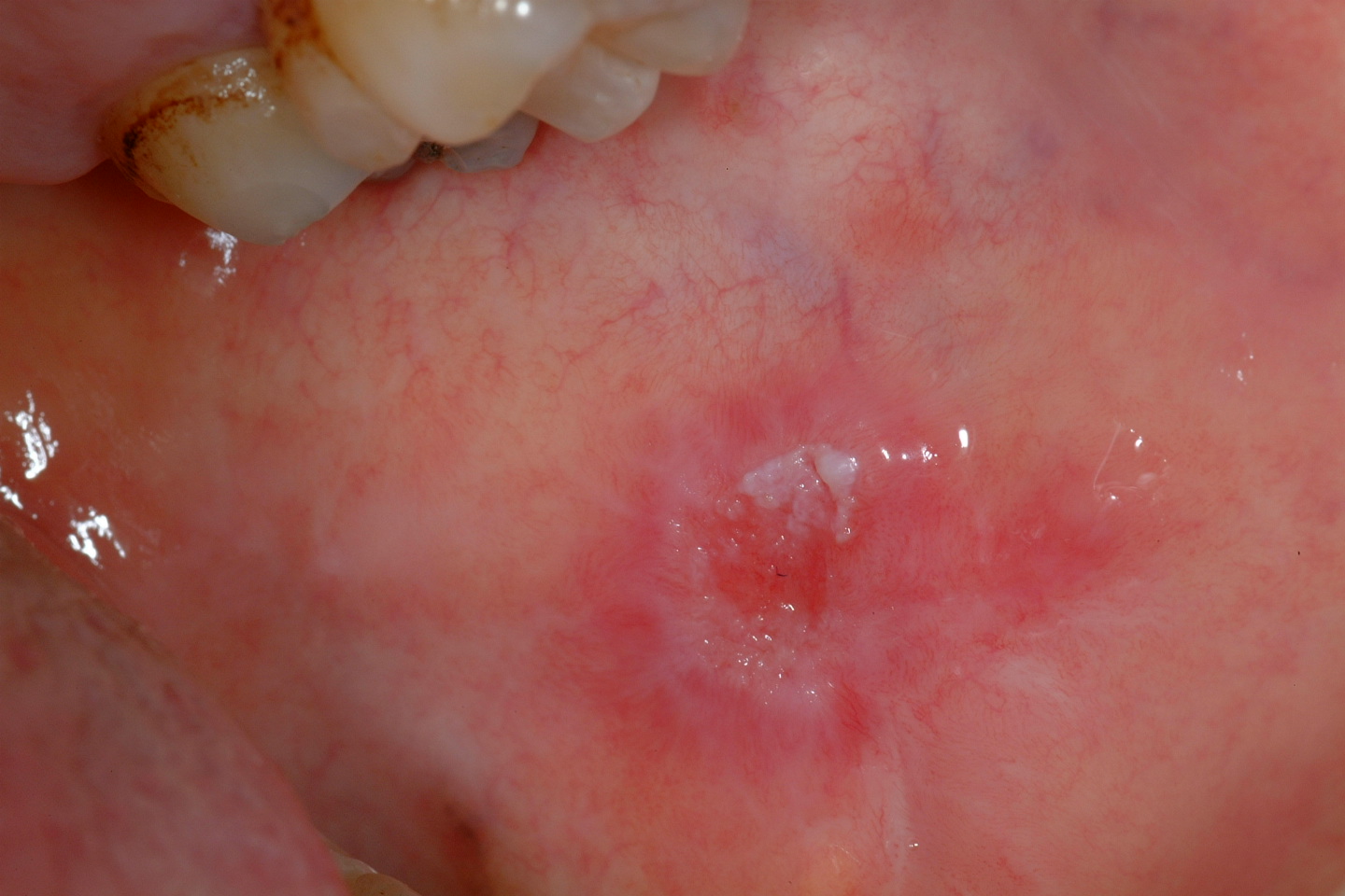 speckled leukoplakia