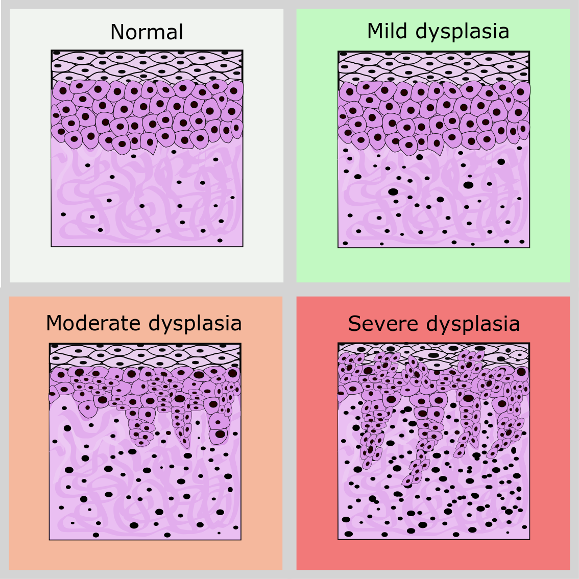 Metaplasia Dysplasia Neoplasia