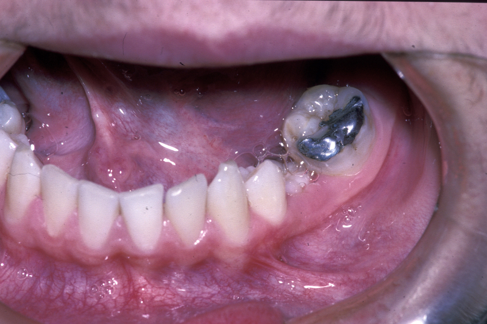 Ectopic (displaced) teeth