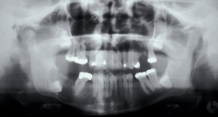 Ectopic (displaced) teeth