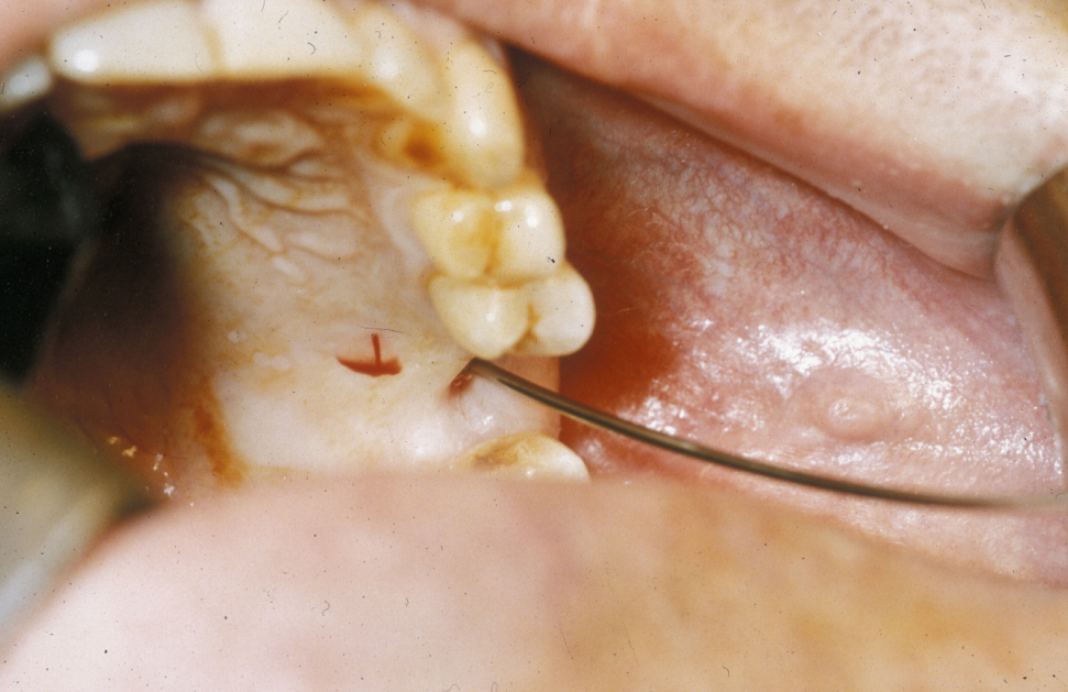 Draining Fistula Dental Best Drain Photos Primagemorg