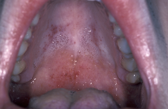 pericoronitis infection