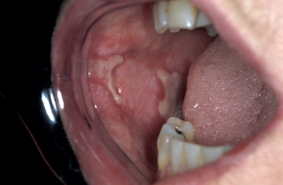 lesion Oral mucosal