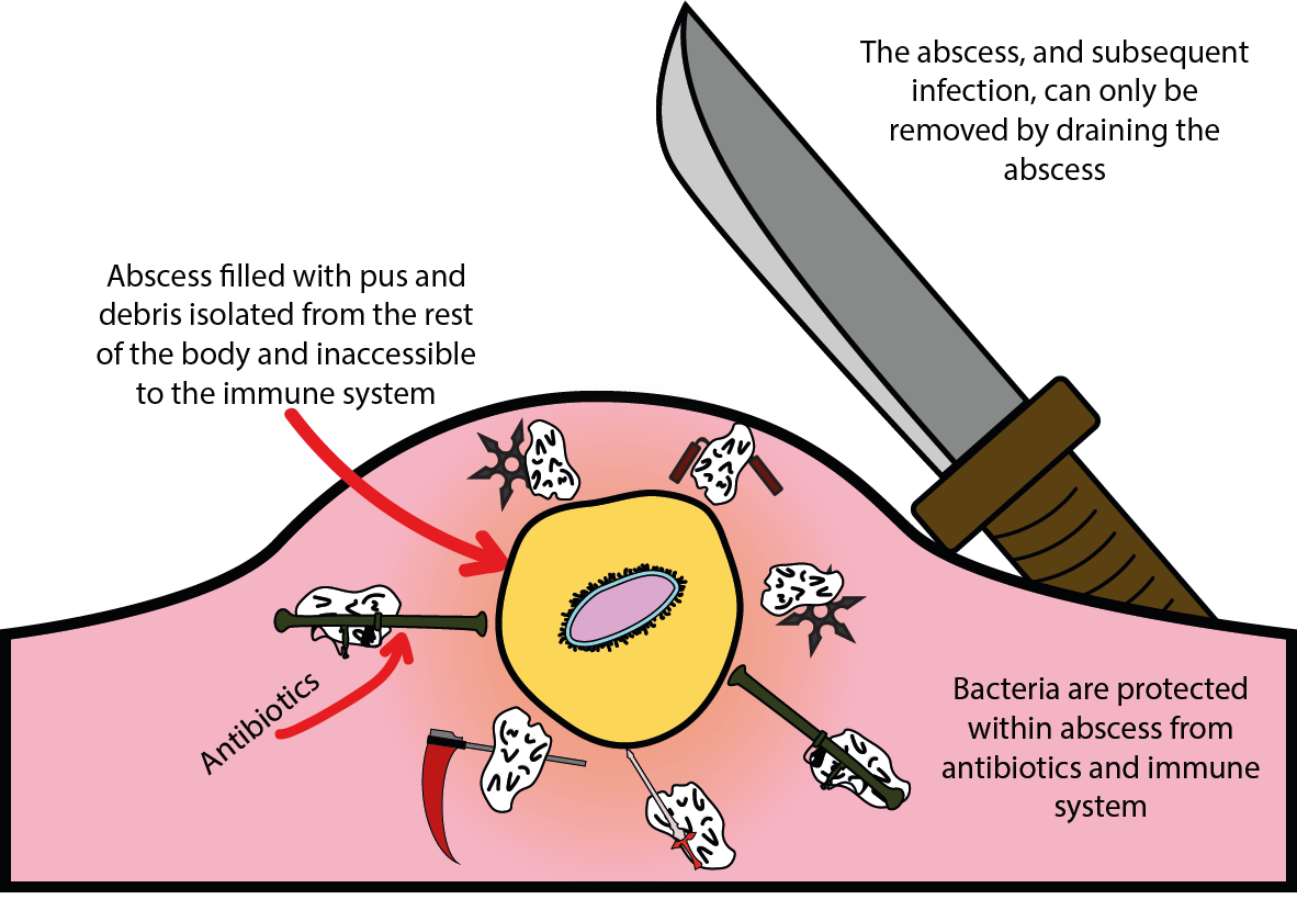 abscess