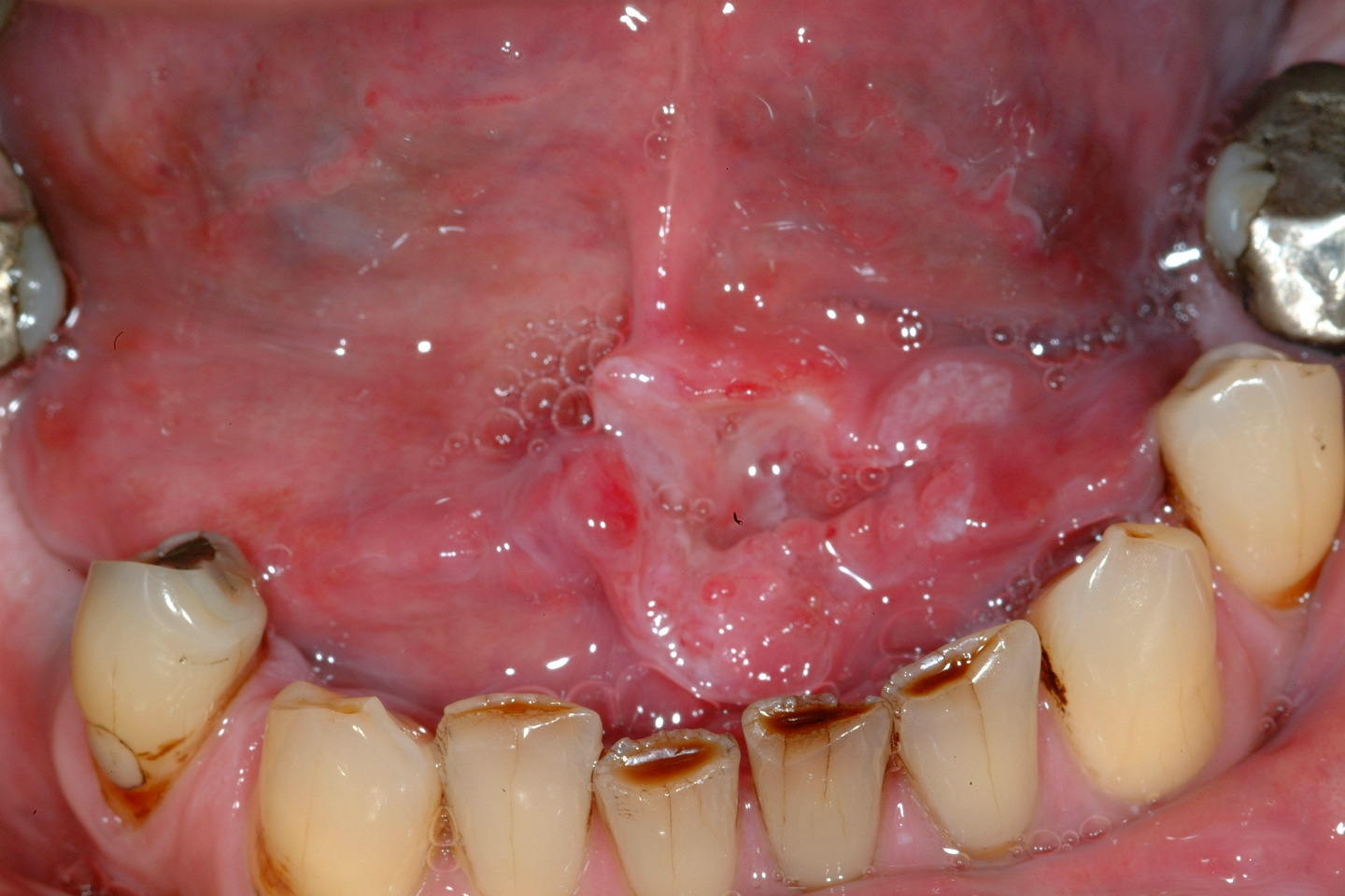 Floor Of Mouth Cancer Home Alqu floor-of-mouth-cancer-home-alqu