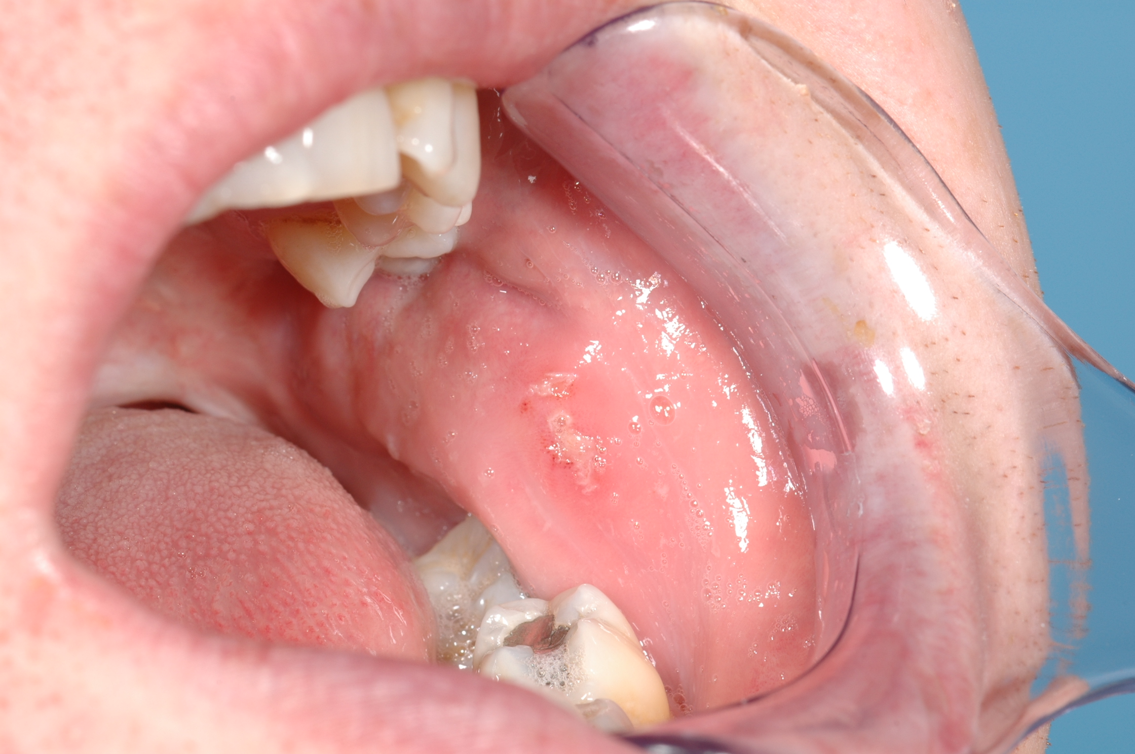 Oral Mucosal Lesions