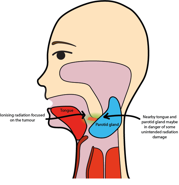 External Radiation Therapy Neck - All About Radiation