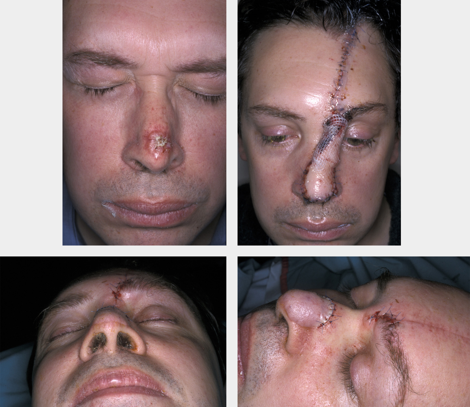 Basal Cell Carcinoma Removal Face