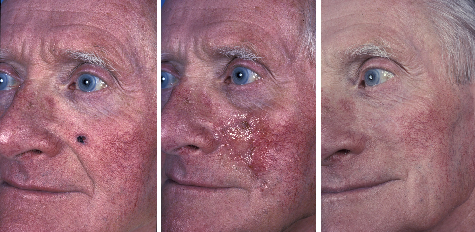 Face Skin Cancer Types