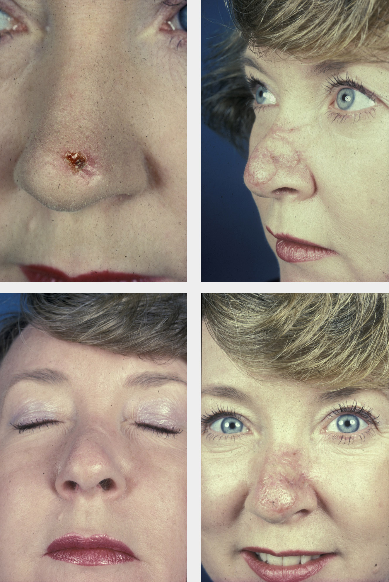 Basal Cell Carcinoma Removal Face