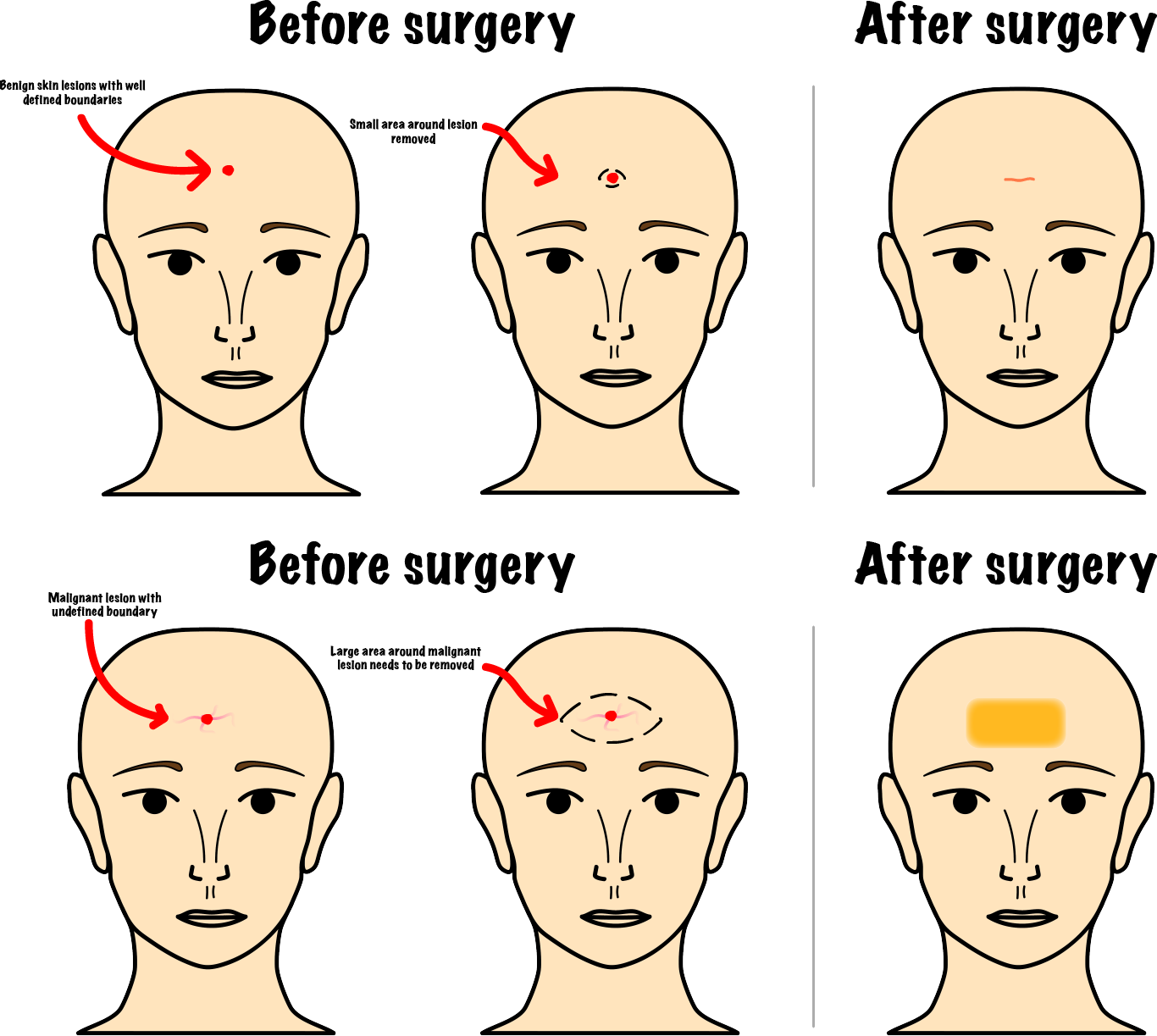 Facial Skin Cancer