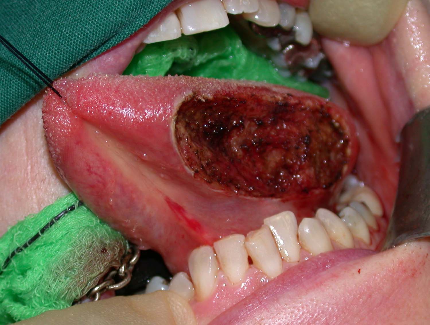 oral cancer surgery