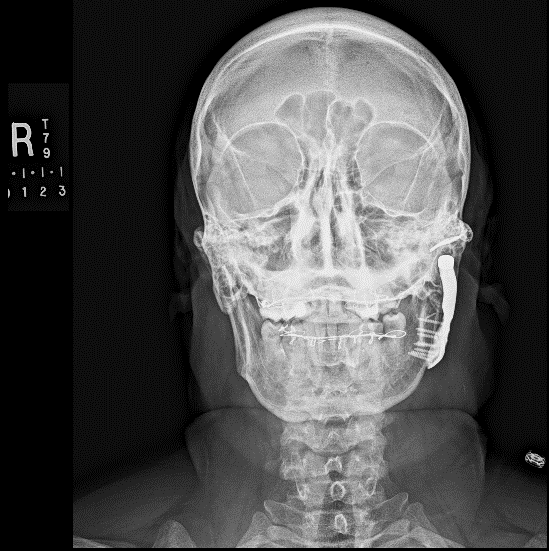 Jaw joint problems